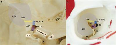 Endoscopic transorbital extradural anterior clinoidectomy: A stepwise surgical technique and case series study [SevEN-013]